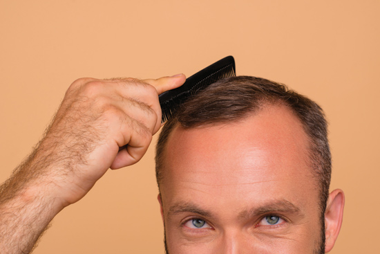 hairstyles for balding men